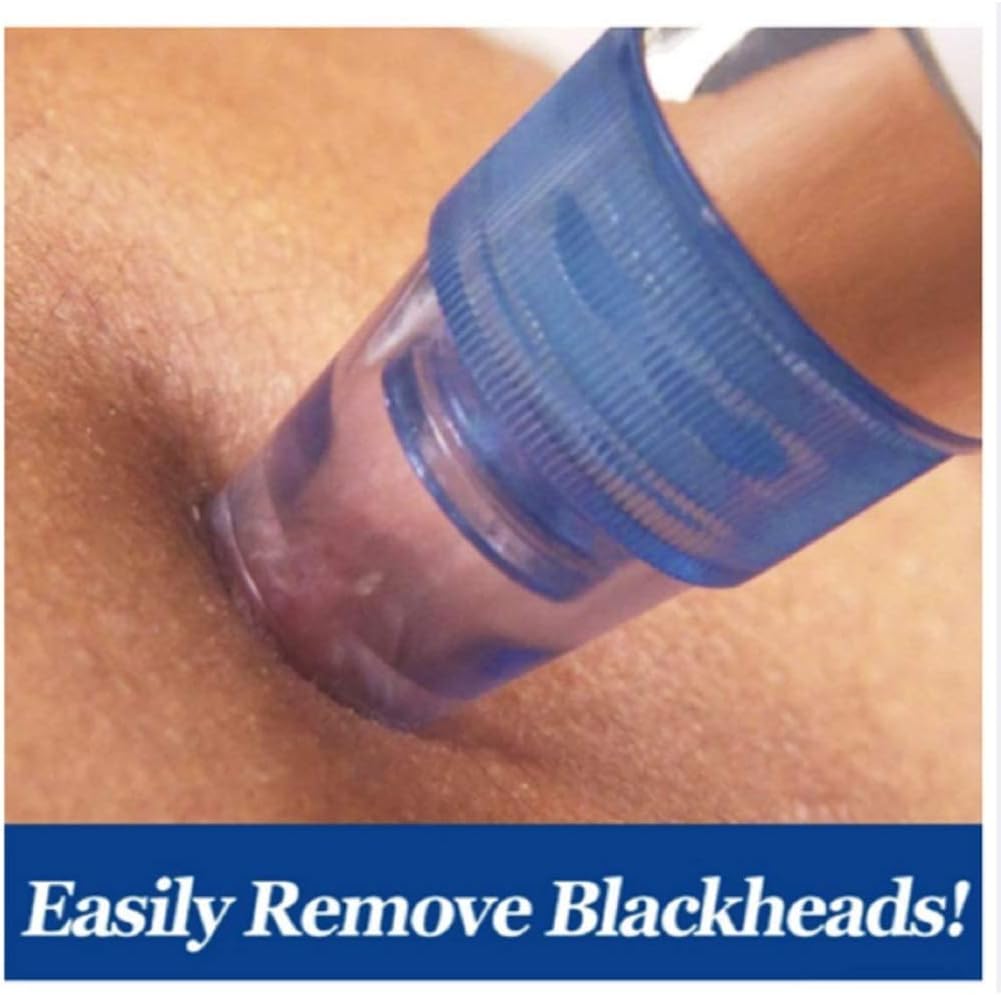 Pore Cleaning Device Blue blackhead removal tool being used on skin with text 'Easily Remove Blackheads!'