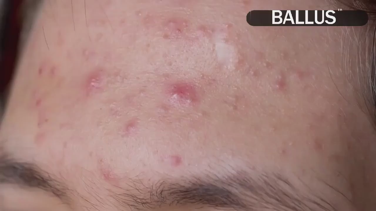 Showing how to use of Pore Cleaning Device for better result. 